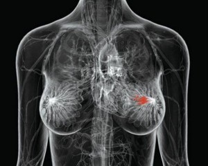 Ενα γονίδιο που αποτελεί «κλειδί» για την εμφάνιση ...δύστροπων καρκίνων του μαστού, ανακάλυψαν αμερικανοί ειδικοί ανοίγοντας τον δρόμο για νέες θεραπείες